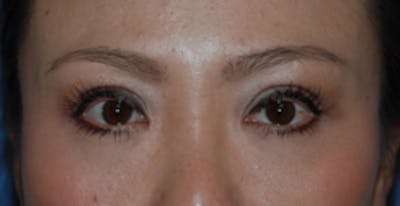 Asian / Ethnic Surgery Before & After Gallery - Patient 333844 - Image 2