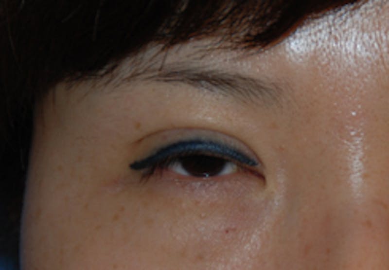 Asian / Ethnic Surgery Before & After Gallery - Patient 277707 - Image 1