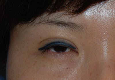 Asian / Ethnic Surgery Before & After Gallery - Patient 277707 - Image 1