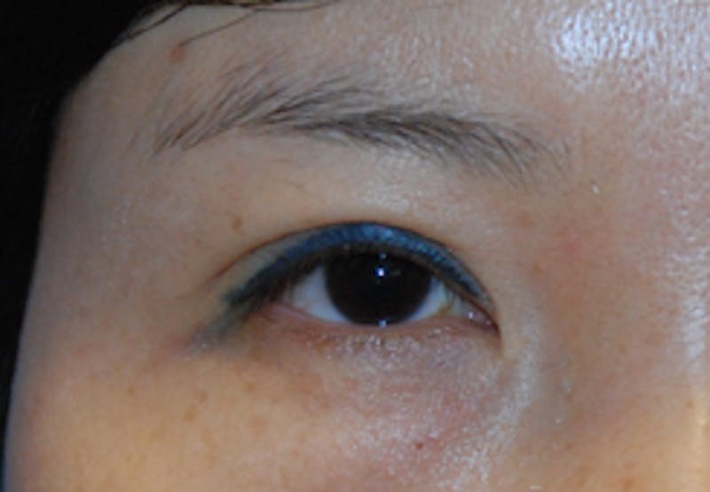 Asian / Ethnic Surgery Before & After Gallery - Patient 277707 - Image 2