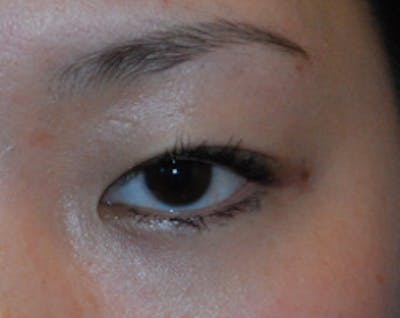 Asian / Ethnic Surgery Before & After Gallery - Patient 833391 - Image 1