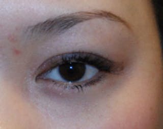 Eye Lift Before & After Gallery - Patient 144972 - Image 4