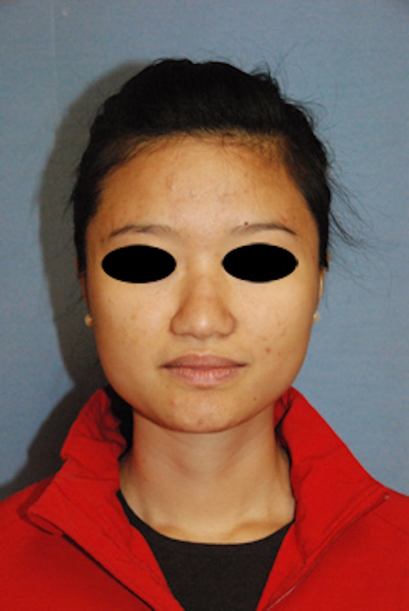 Asian / Ethnic Surgery Before & After Gallery - Patient 233781 - Image 1