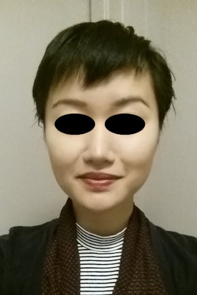 Rhinoplasty Before & After Gallery - Patient 264039 - Image 2