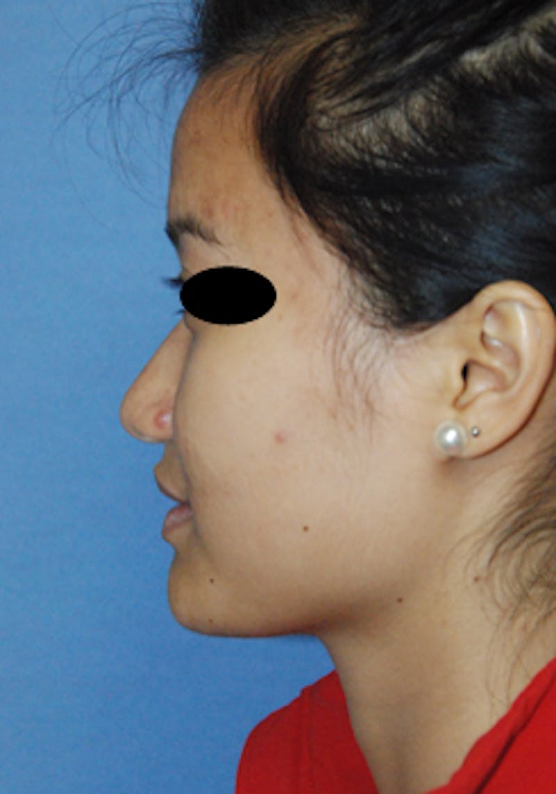 Asian / Ethnic Surgery Before & After Gallery - Patient 233781 - Image 3