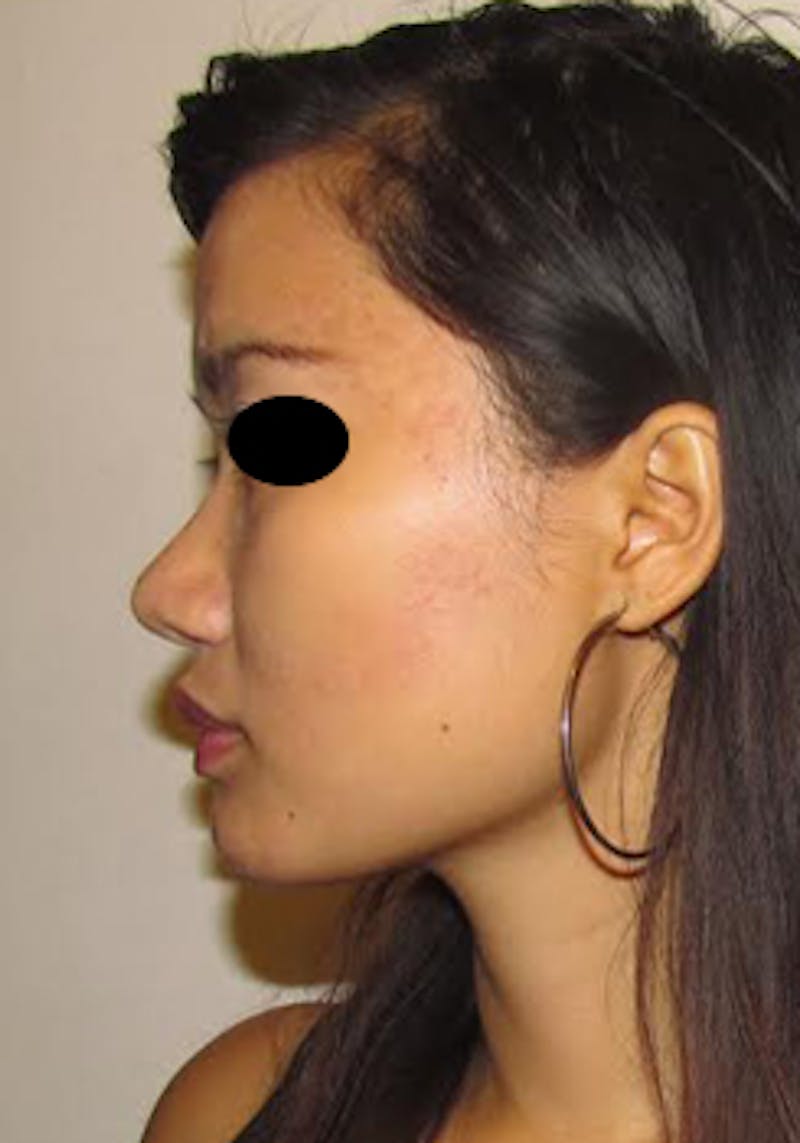 Asian / Ethnic Surgery Before & After Gallery - Patient 233781 - Image 4