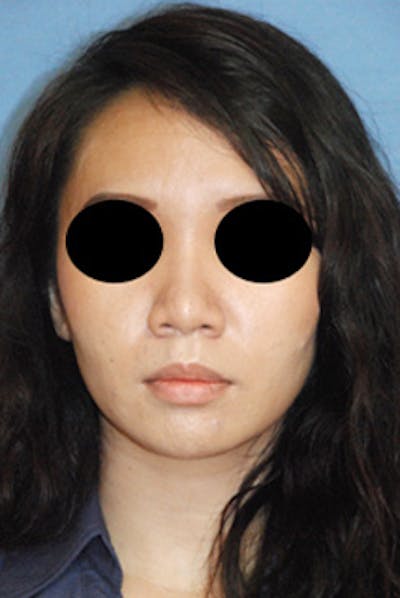 Rhinoplasty Before & After Gallery - Patient 125375 - Image 1