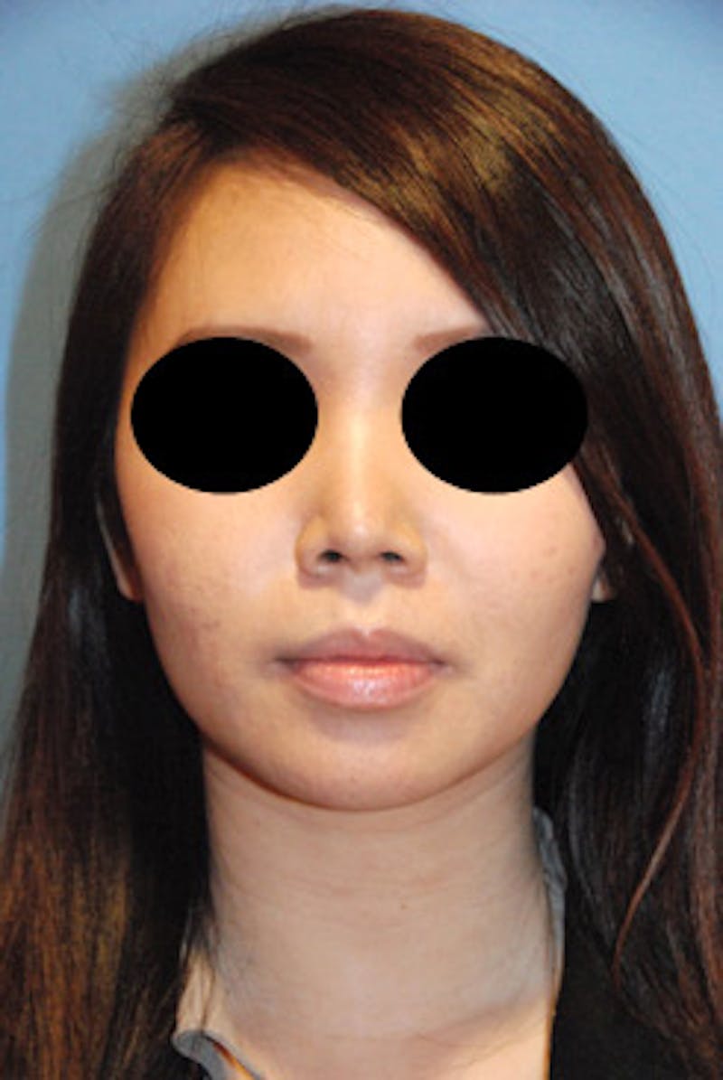 Rhinoplasty Before & After Gallery - Patient 125375 - Image 2