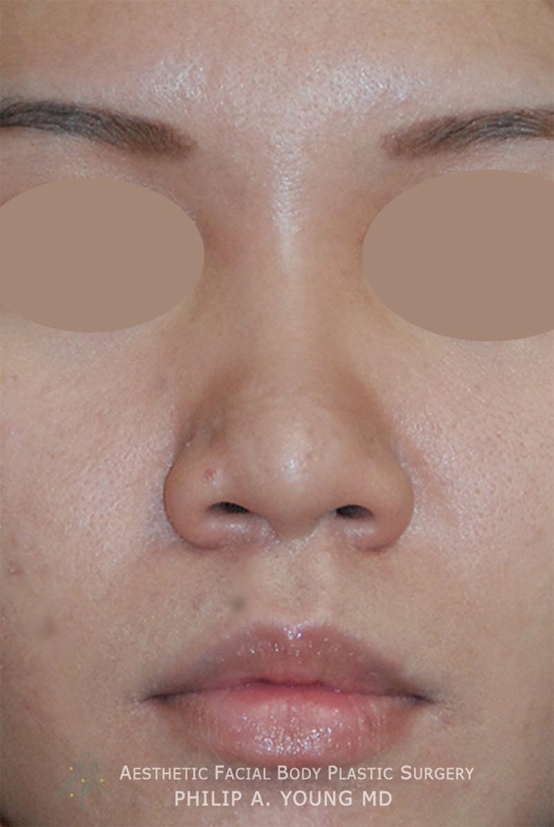 Rhinoplasty Before & After Gallery - Patient 125375 - Image 3
