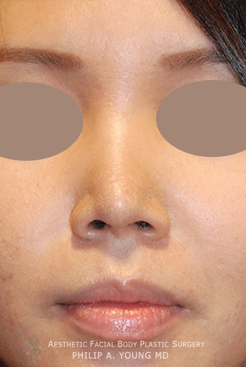Rhinoplasty Before & After Gallery - Patient 125375 - Image 4