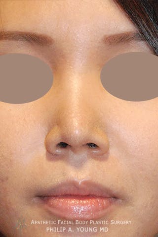 Asian / Ethnic Surgery Before & After Gallery - Patient 104502 - Image 4