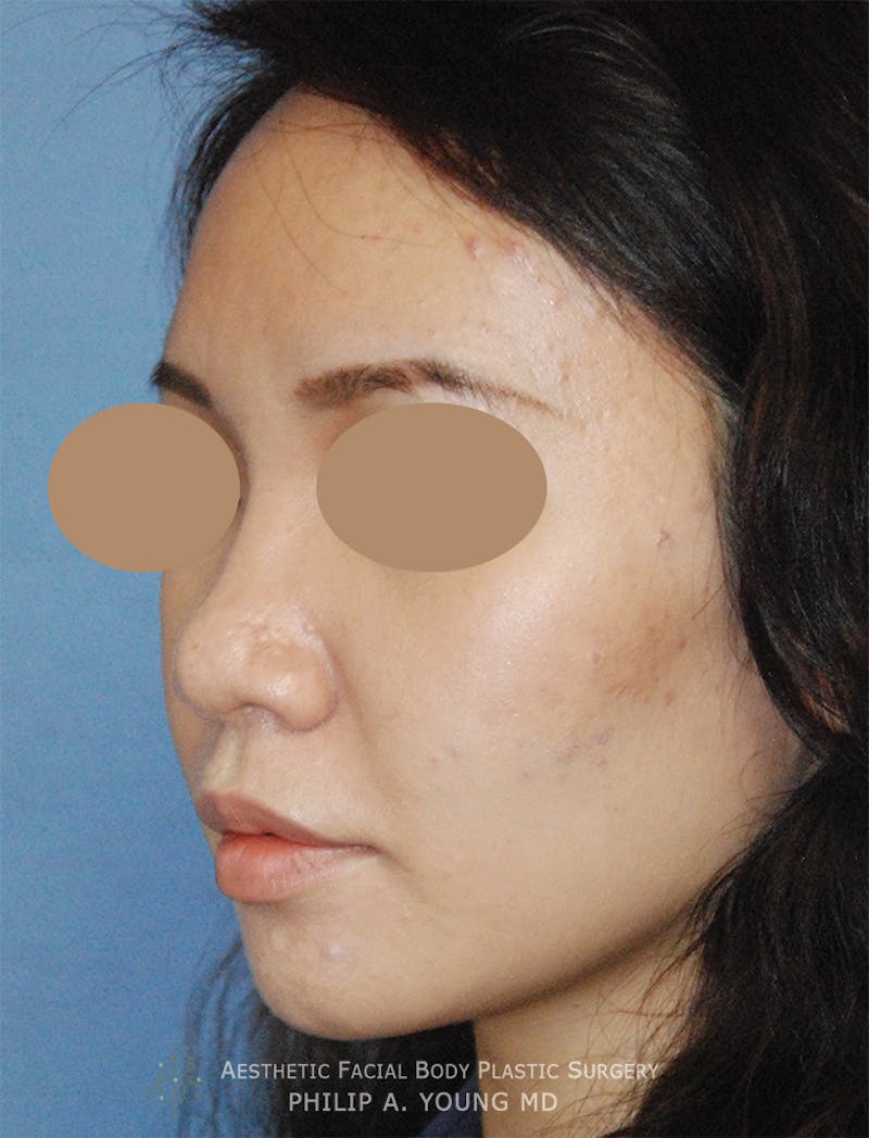Rhinoplasty Before & After Gallery - Patient 125375 - Image 5