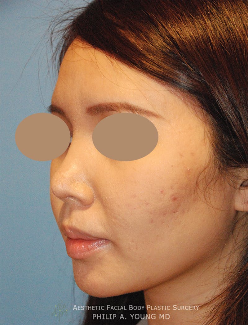 Rhinoplasty Before & After Gallery - Patient 125375 - Image 6