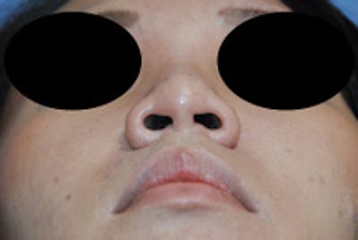 Asian / Ethnic Surgery Before & After Gallery - Patient 466325 - Image 1