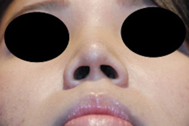 Rhinoplasty Before & After Gallery - Patient 125375 - Image 8