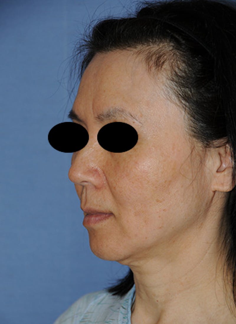 Jaw Implants Before & After Gallery - Patient 368553 - Image 1