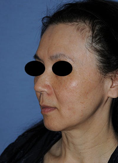 Asian / Ethnic Surgery Before & After Gallery - Patient 250031 - Image 2