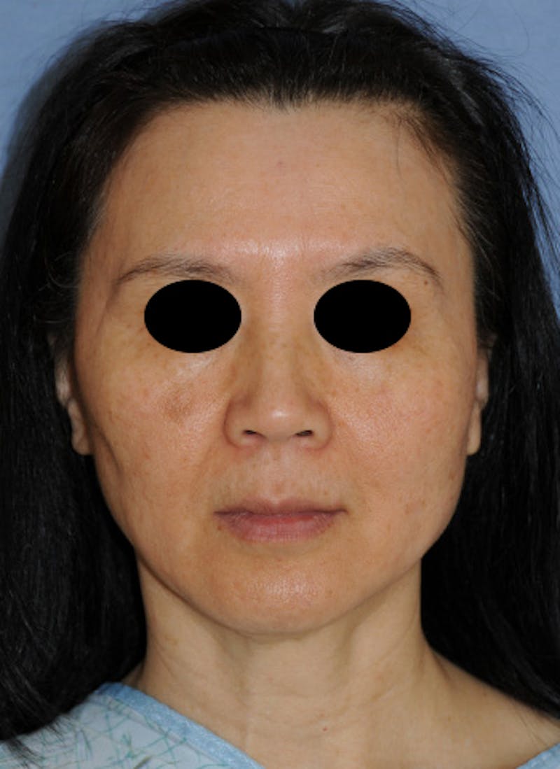 Jaw Implants Before & After Gallery - Patient 368553 - Image 3
