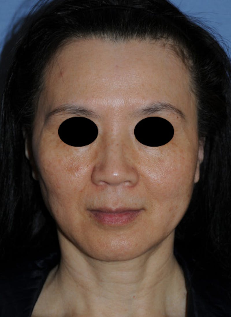 Jaw Implants Before & After Gallery - Patient 368553 - Image 4