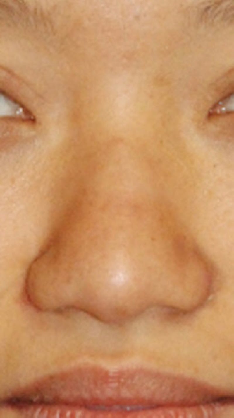 Asian / Ethnic Surgery Before & After Gallery - Patient 327254 - Image 1