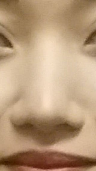 Asian Rhinoplasty Before & After Gallery - Patient 165290 - Image 6