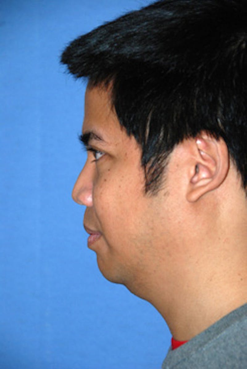 Asian / Ethnic Surgery Before & After Gallery - Patient 200739 - Image 1
