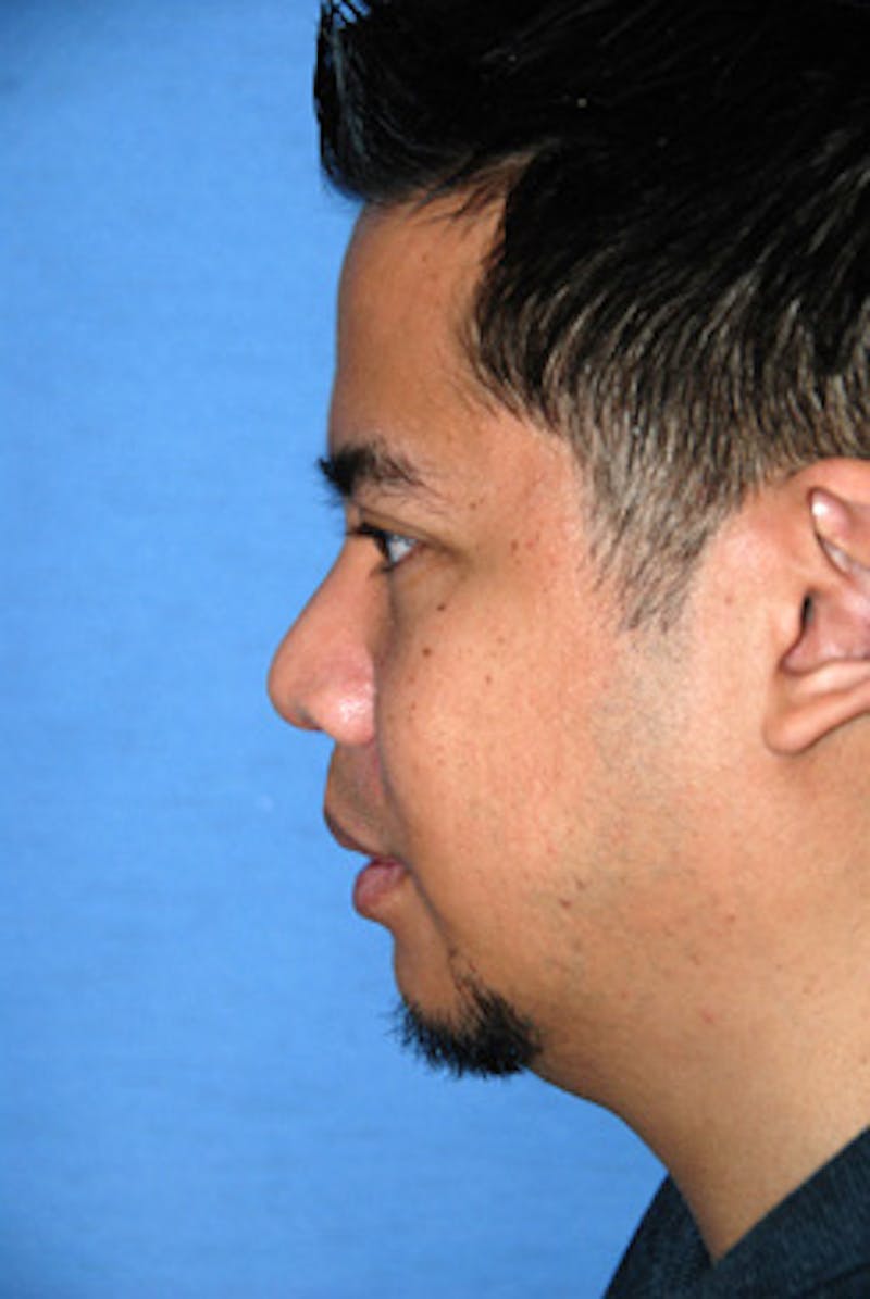 Asian / Ethnic Surgery Before & After Gallery - Patient 200739 - Image 2