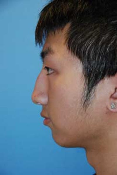 Asian / Ethnic Surgery Before & After Gallery - Patient 402764 - Image 1