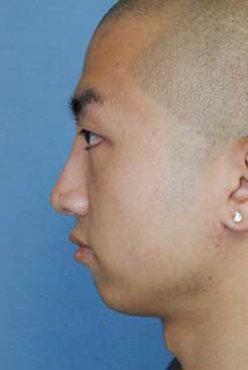 Asian / Ethnic Surgery Before & After Gallery - Patient 402764 - Image 2