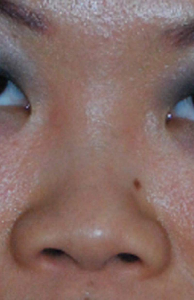 Asian / Ethnic Surgery Before & After Gallery - Patient 428538 - Image 1