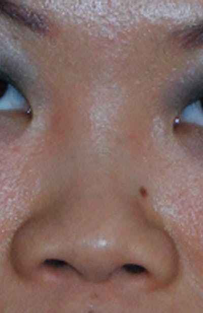 Asian / Ethnic Surgery Before & After Gallery - Patient 428538 - Image 1