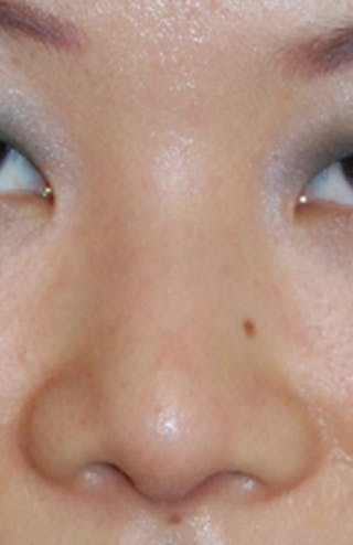 Asian / Ethnic Surgery Before & After Gallery - Patient 428538 - Image 2