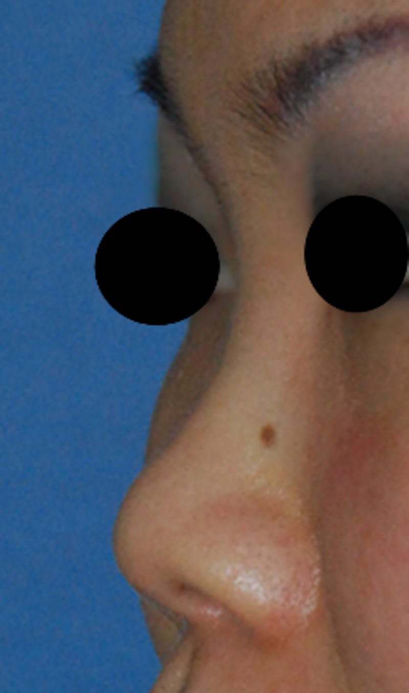 Asian / Ethnic Surgery Before & After Gallery - Patient 428538 - Image 3