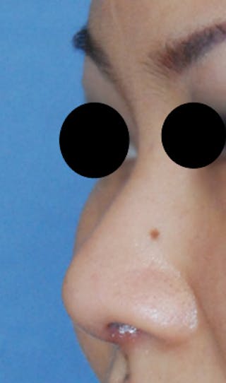 Asian / Ethnic Surgery Before & After Gallery - Patient 428538 - Image 4