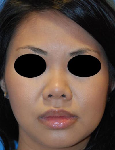 Rhinoplasty Before & After Gallery - Patient 161666 - Image 1