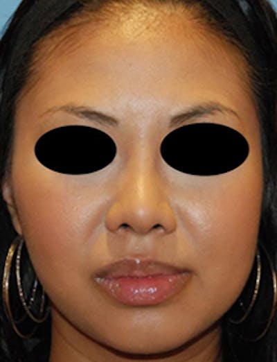 Rhinoplasty Before & After Gallery - Patient 161666 - Image 2