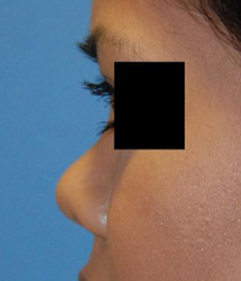 Asian / Ethnic Surgery Before & After Gallery - Patient 784901 - Image 3