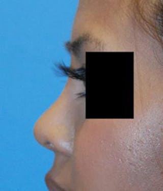 Asian Rhinoplasty Before & After Gallery - Patient 638871 - Image 2