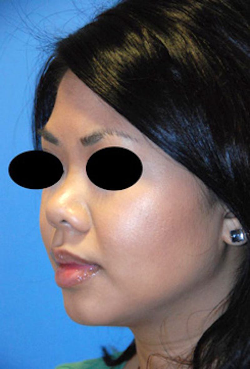Asian / Ethnic Surgery Before & After Gallery - Patient 784901 - Image 5