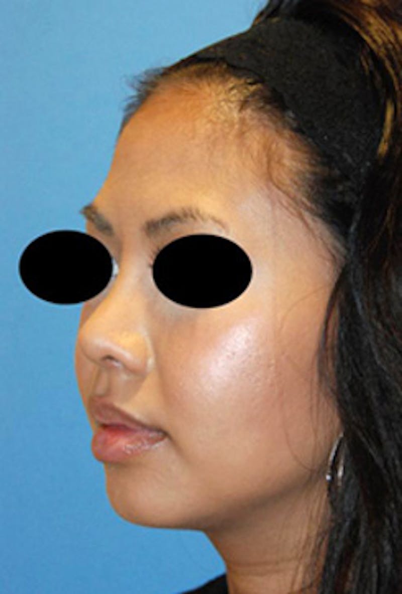 Asian / Ethnic Surgery Before & After Gallery - Patient 784901 - Image 6