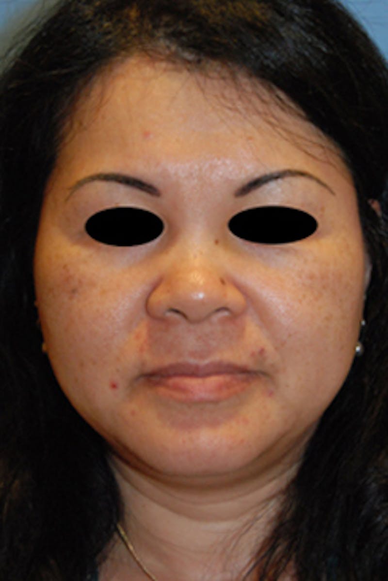 Asian / Ethnic Surgery Before & After Gallery - Patient 392090 - Image 1