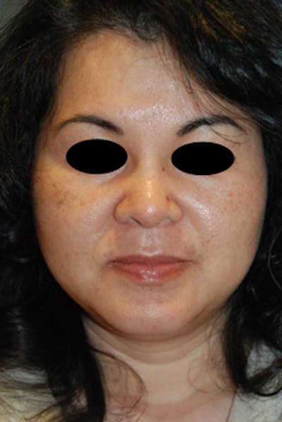 Rhinoplasty Before & After Gallery - Patient 357793 - Image 2