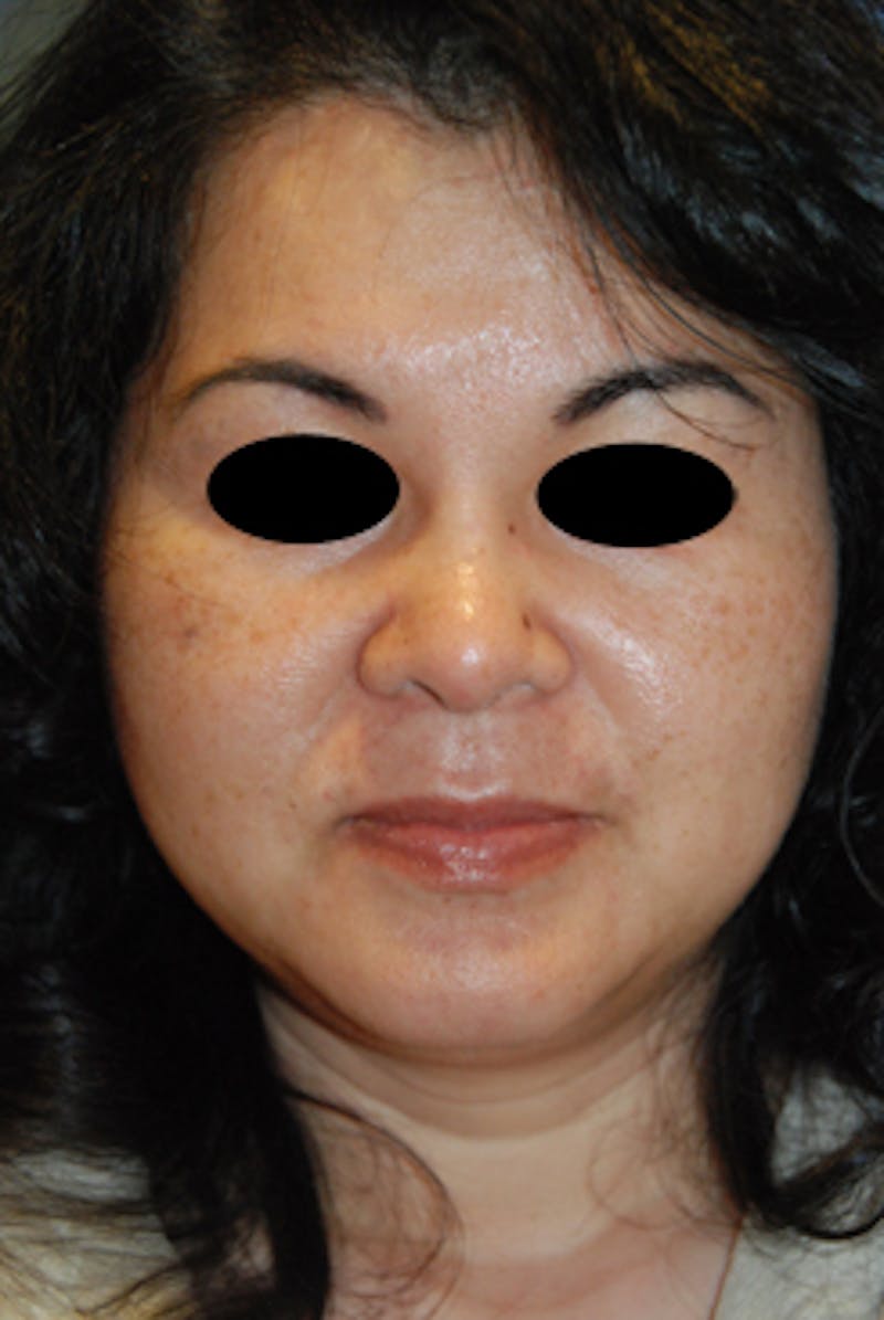 Asian / Ethnic Surgery Before & After Gallery - Patient 392090 - Image 2