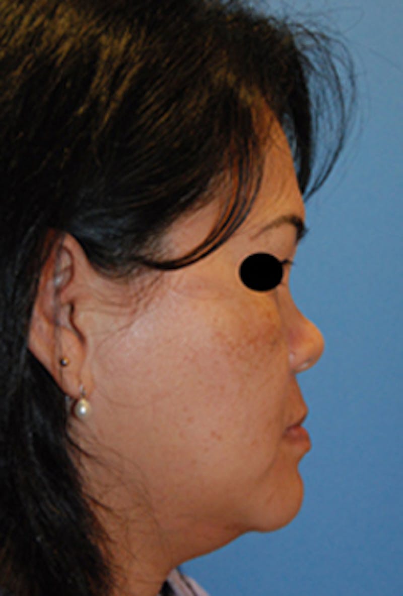 Asian / Ethnic Surgery Before & After Gallery - Patient 392090 - Image 3