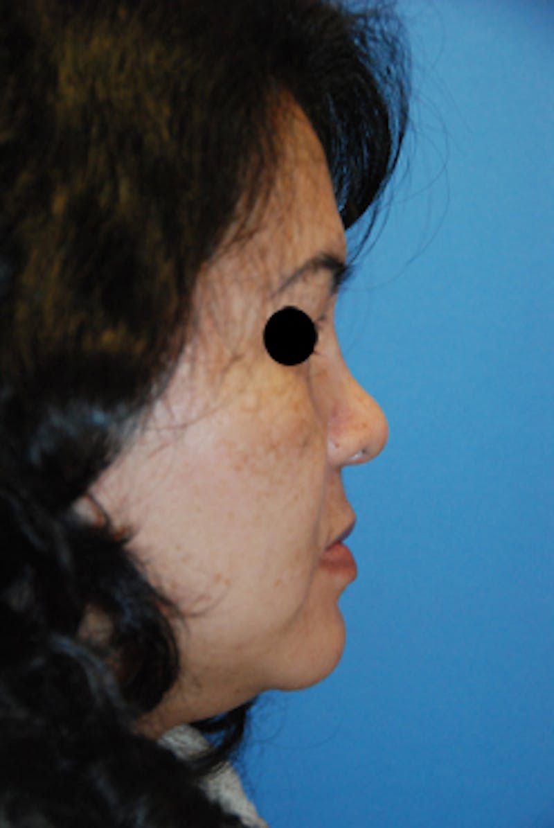 Asian / Ethnic Surgery Before & After Gallery - Patient 392090 - Image 4