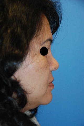 Rhinoplasty Before & After Gallery - Patient 357793 - Image 4