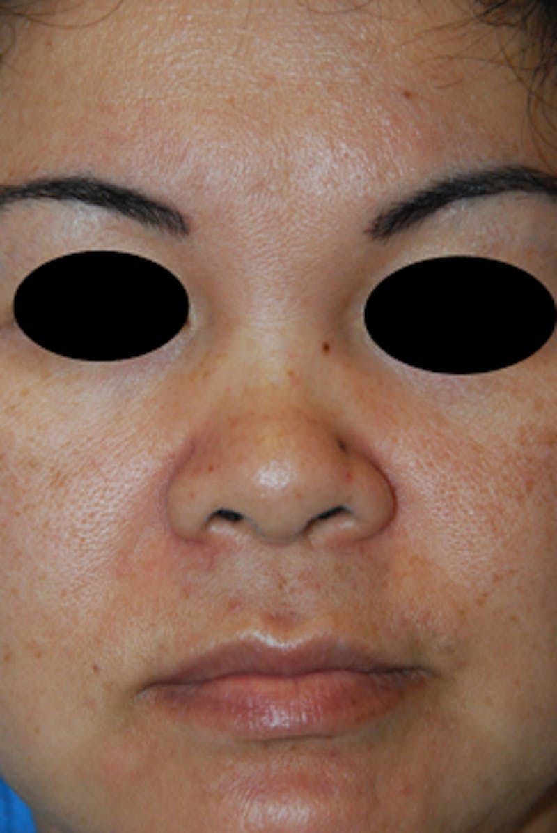 Asian / Ethnic Surgery Before & After Gallery - Patient 392090 - Image 5
