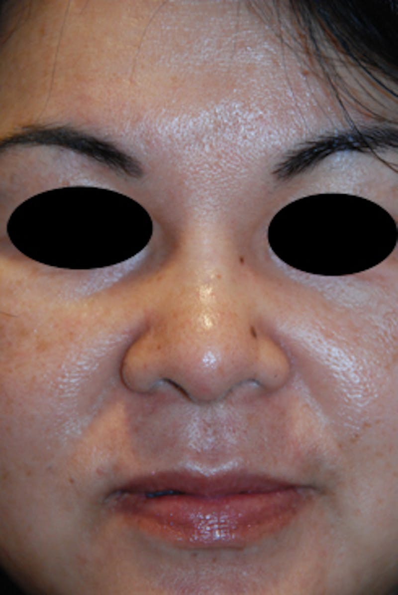 Asian / Ethnic Surgery Before & After Gallery - Patient 392090 - Image 6