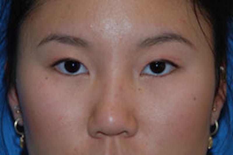 Asian / Ethnic Surgery Before & After Gallery - Patient 161441 - Image 1