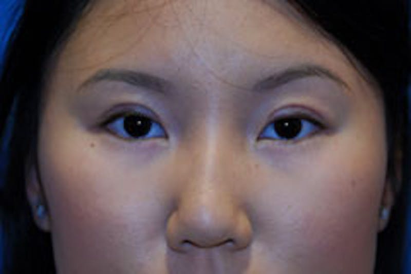 Asian / Ethnic Surgery Before & After Gallery - Patient 161441 - Image 2